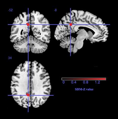 A Voxel-Wise Meta-Analysis of Gray Matter Abnormalities in Essential Tremor